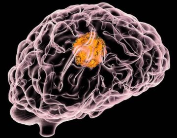 سستے سپلیمنٹس دنیا کے مہلک ترین دماغی کینسروں میں سے ایک کی شفا میں امید افزا ثابت