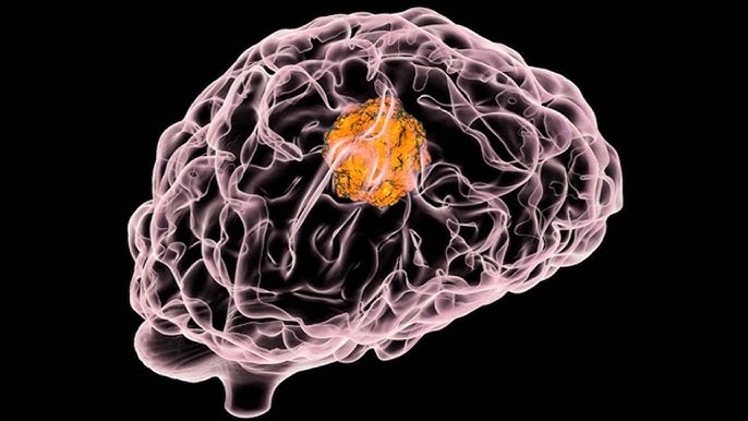 سستے سپلیمنٹس دنیا کے مہلک ترین دماغی کینسروں میں سے ایک کی شفا میں امید افزا ثابت