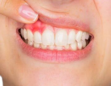 مسوڑھوں کی بیماری دماغ کے سفید مادے کے نقصان سے منسلک ہے۔