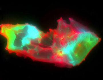 سائنسدانوں نے طویل COVID میں خون کے پوشیدہ نمونے کو بے نقاب کیا۔