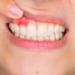 دانتوں کا یہ عام مسئلہ آپ کے دماغ کو خطرہ بنا سکتا ہے۔