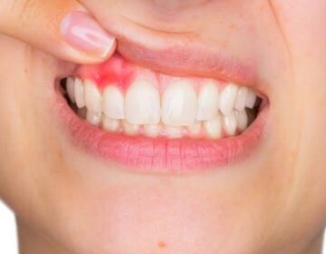 دانتوں کا یہ عام مسئلہ آپ کے دماغ کو خطرہ بنا سکتا ہے۔