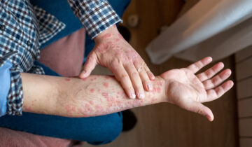 آپ کی جلد آپ کو دماغی صحت کی پریشانی کے بارے میں خبردار کر سکتی ہے۔