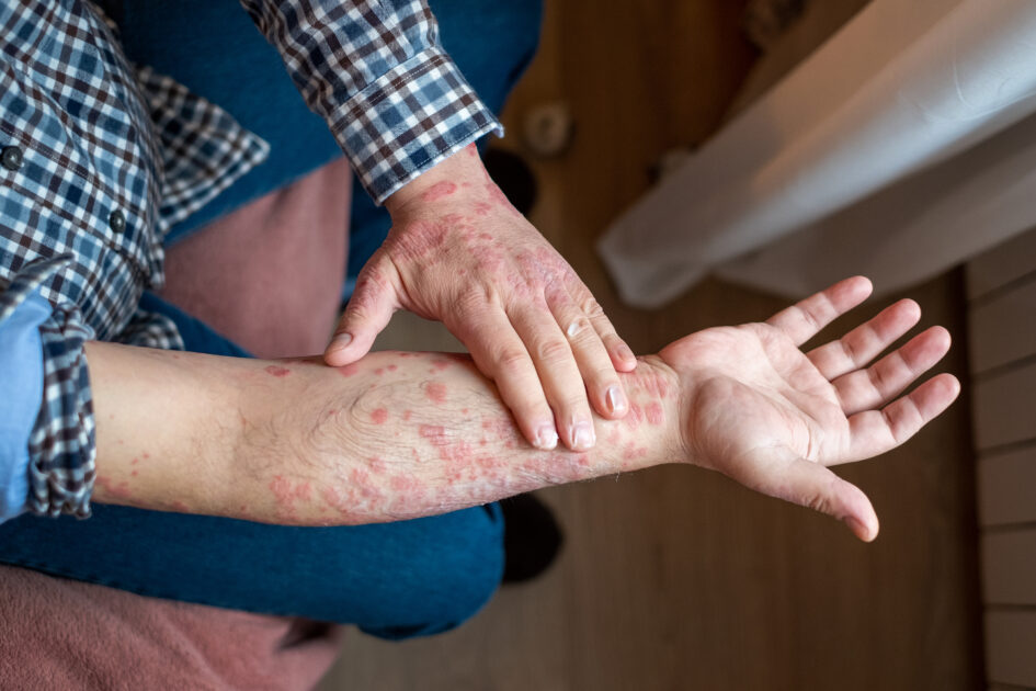 آپ کی جلد آپ کو دماغی صحت کی پریشانی کے بارے میں خبردار کر سکتی ہے۔