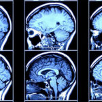 دماغ کا نیا سگنل الزائمر کی تشخیص سے کئی سال پہلے پیش گوئی کرتا ہے۔