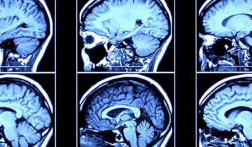 دماغ کا نیا سگنل الزائمر کی تشخیص سے کئی سال پہلے پیش گوئی کرتا ہے۔