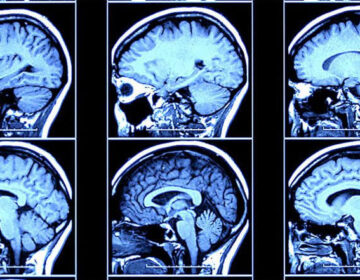 دماغ کا نیا سگنل الزائمر کی تشخیص سے کئی سال پہلے پیش گوئی کرتا ہے۔