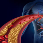 ہائی کولیسٹرول مستقبل میں دل کی بیماری کے خطرے کی پیش گوئی کر سکتا ہے، یہاں تک کہ صحت مند خواتین میں بھی
