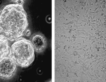 کیا ایک عام وٹامن انتہائی جارحانہ دماغی کینسر سے لڑ سکتا ہے؟