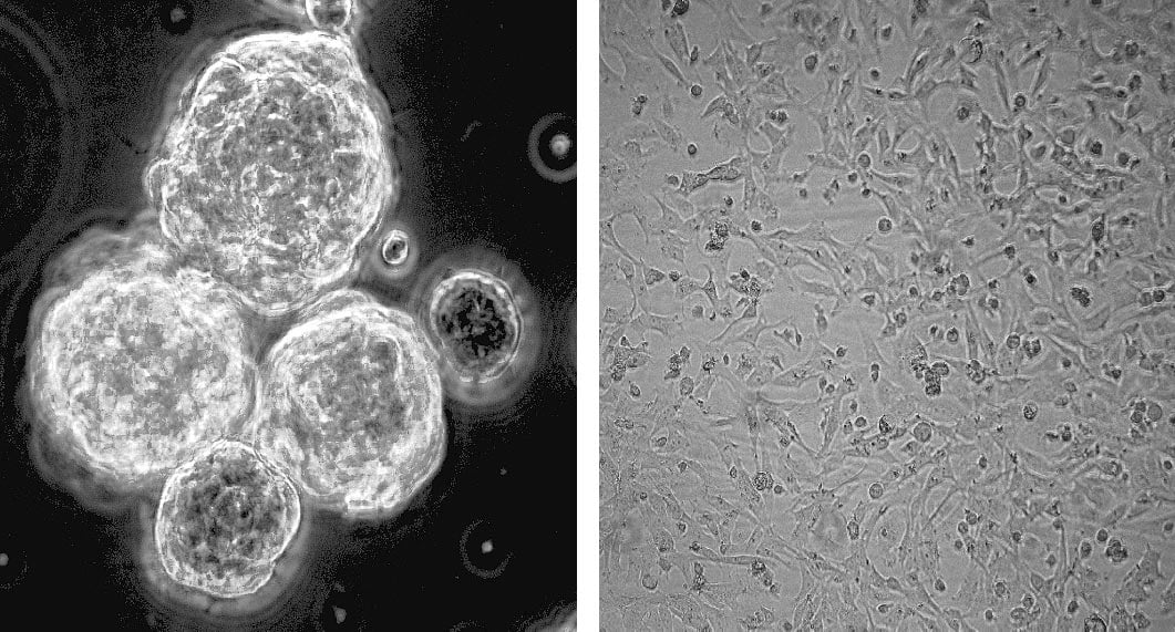 کیا ایک عام وٹامن انتہائی جارحانہ دماغی کینسر سے لڑ سکتا ہے؟