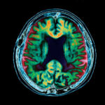 دماغی خون کا بہاؤ یادداشت کی کمی سے پہلے الزائمر کے خطرے کی پیش گوئی کر سکتا ہے۔