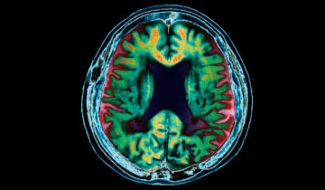 دماغی خون کا بہاؤ یادداشت کی کمی سے پہلے الزائمر کے خطرے کی پیش گوئی کر سکتا ہے۔