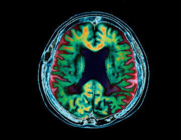 دماغی خون کا بہاؤ یادداشت کی کمی سے پہلے الزائمر کے خطرے کی پیش گوئی کر سکتا ہے۔