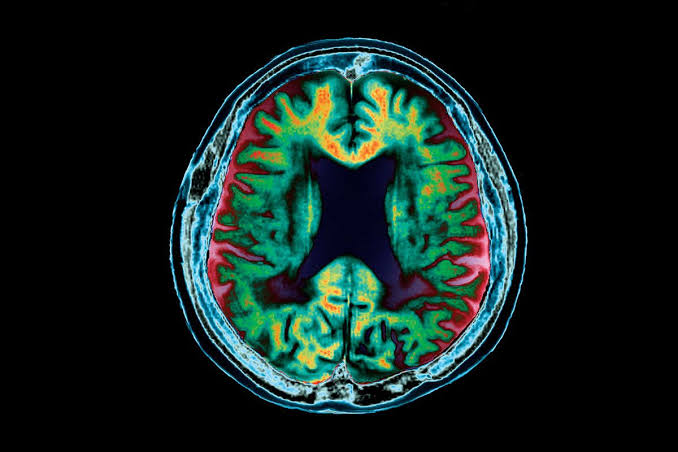 دماغی خون کا بہاؤ یادداشت کی کمی سے پہلے الزائمر کے خطرے کی پیش گوئی کر سکتا ہے۔