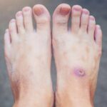 ذیابیطس کے زخم کیوں بھرنے سے انکار کرتے ہیں۔