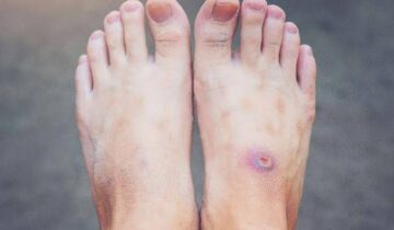 ذیابیطس کے زخم کیوں بھرنے سے انکار کرتے ہیں۔