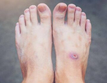 ذیابیطس کے زخم کیوں بھرنے سے انکار کرتے ہیں۔