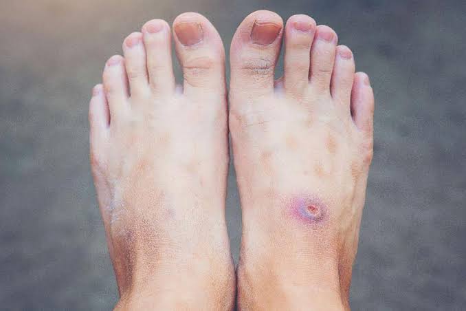 ذیابیطس کے زخم کیوں بھرنے سے انکار کرتے ہیں۔