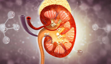 کیوں زیادہ پانی پینا گردے کی پتھری کو روکنے کے لیے کافی نہیں ہے۔