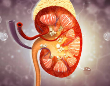 کیوں زیادہ پانی پینا گردے کی پتھری کو روکنے کے لیے کافی نہیں ہے۔