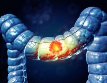 50 سال سے کم عمر افراد میں بڑی آنت اور مقعد کے کینسر (Colorectal cancer) میں اضافہ کیوں ہو رہا ہے؟ نئے اشارے ماحولیاتی عوامل کی جانب نشاندہی کرتے ہیں۔