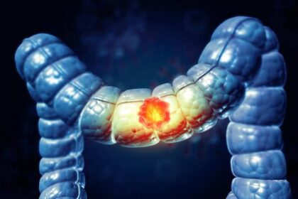 50 سال سے کم عمر افراد میں بڑی آنت اور مقعد کے کینسر (Colorectal cancer) میں اضافہ کیوں ہو رہا ہے؟ نئے اشارے ماحولیاتی عوامل کی جانب نشاندہی کرتے ہیں۔