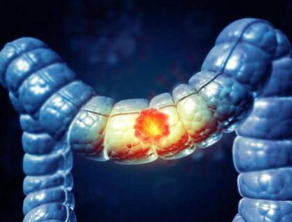50 سال سے کم عمر افراد میں بڑی آنت اور مقعد کے کینسر (Colorectal cancer) میں اضافہ کیوں ہو رہا ہے؟ نئے اشارے ماحولیاتی عوامل کی جانب نشاندہی کرتے ہیں۔