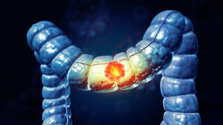 50 سال سے کم عمر افراد میں بڑی آنت اور مقعد کے کینسر (Colorectal cancer) میں اضافہ کیوں ہو رہا ہے؟ نئے اشارے ماحولیاتی عوامل کی جانب نشاندہی کرتے ہیں۔
